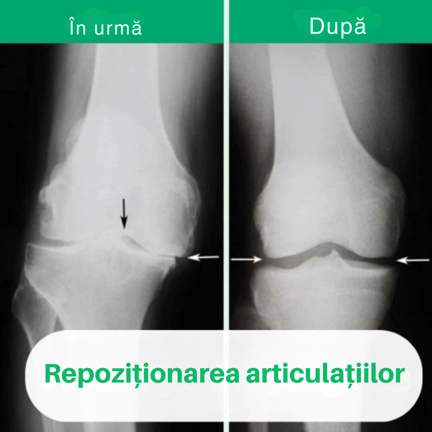 OrthoKnee™ – Ușurare de lungă durată de la artrită și dureri articulare